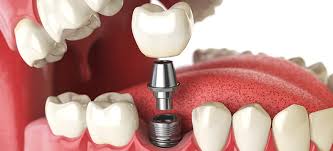Restore Your Smile with Quality Dental Implants Near Me in Rockville